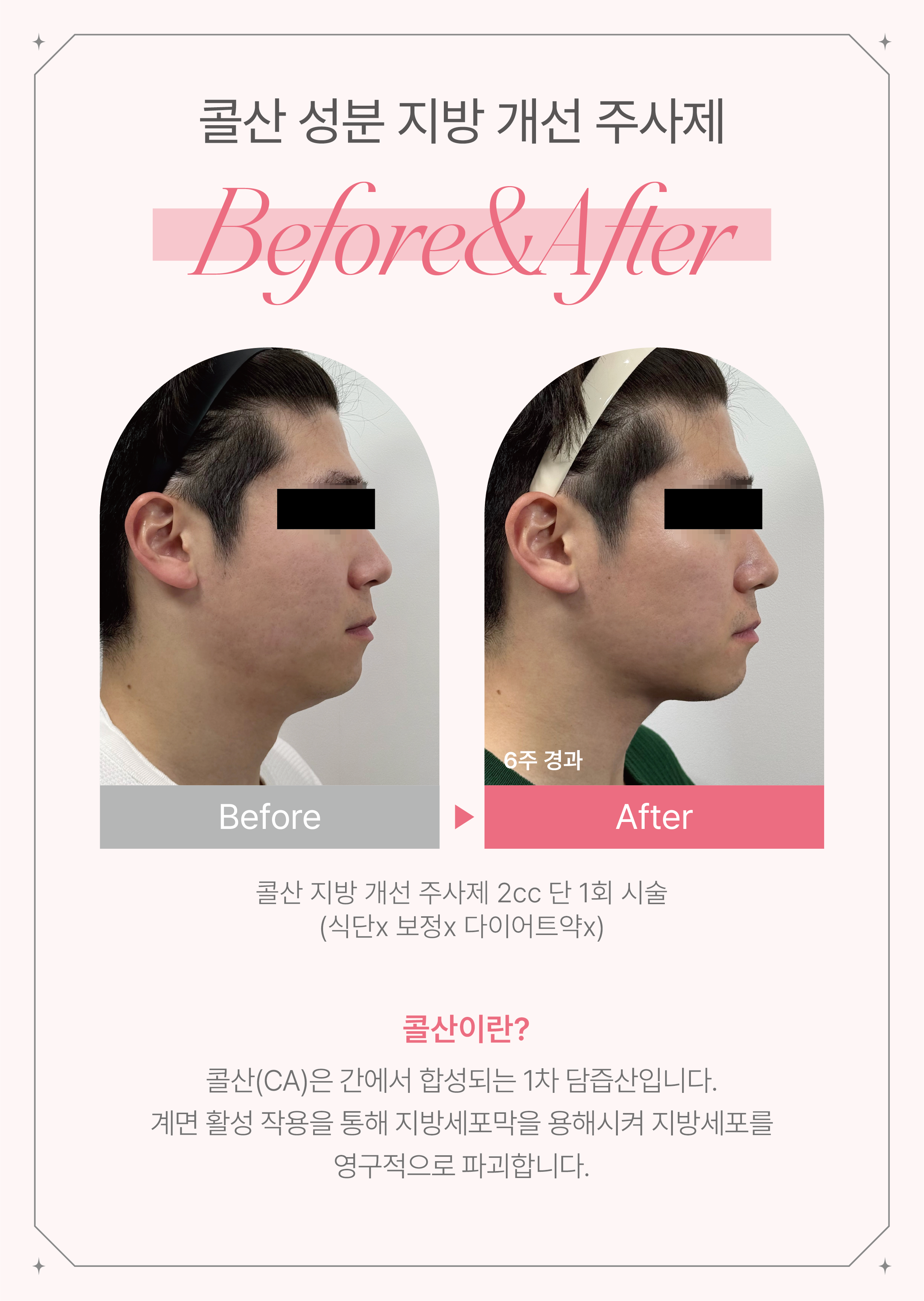 뷰티온의원 수원망포점 :: 뉴비주 지방분해주사 