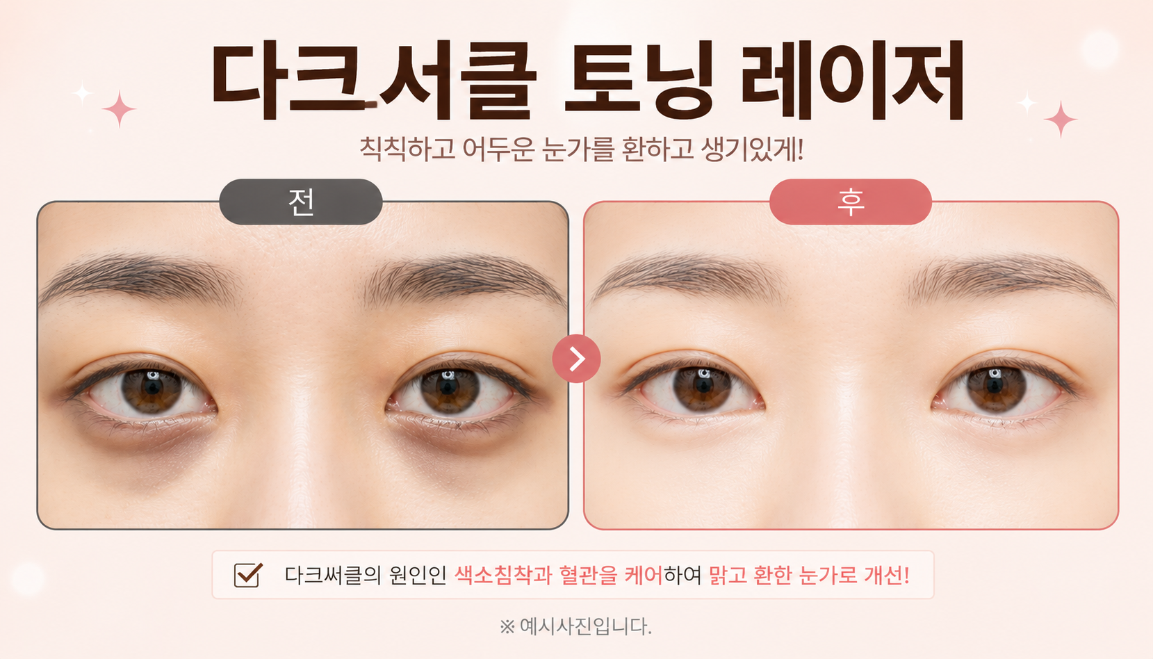 대전도안 뷰티온의원 :: 다크서클 토닝 패키지