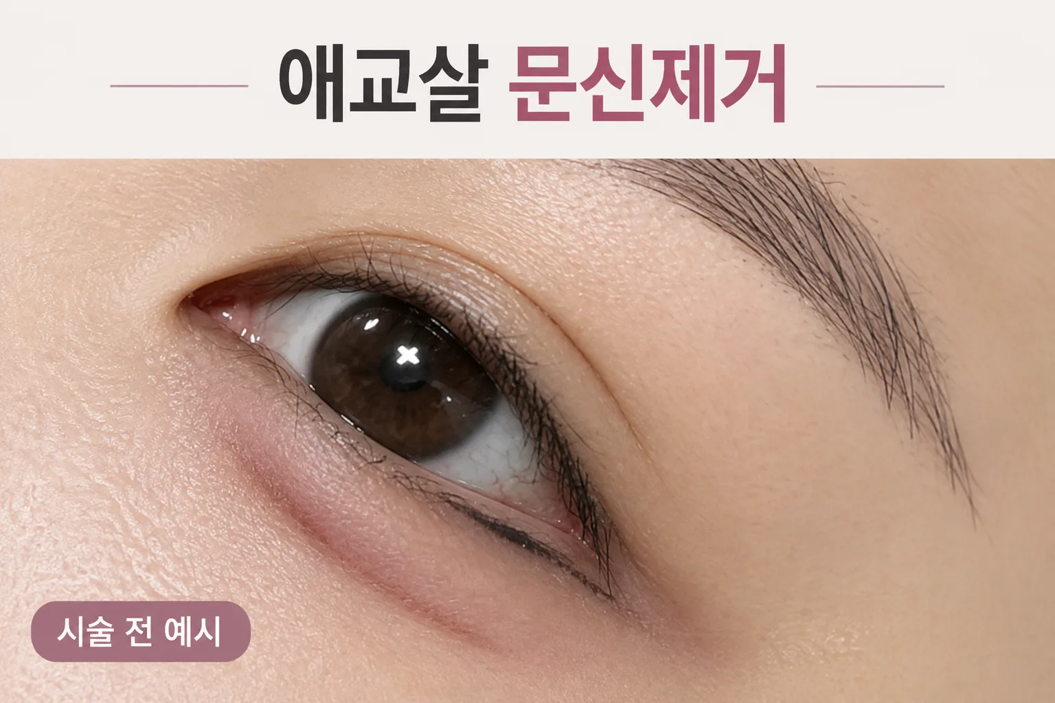 대전피부과 뷰티온의원 대전도안점ㅣ피부 리프팅 보톡스 상담 :: 애교살 문신 제거