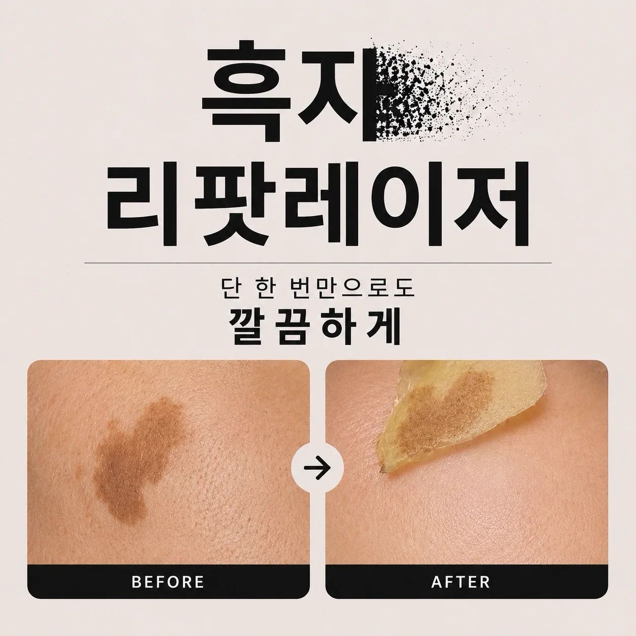 흑자 리팟레이저