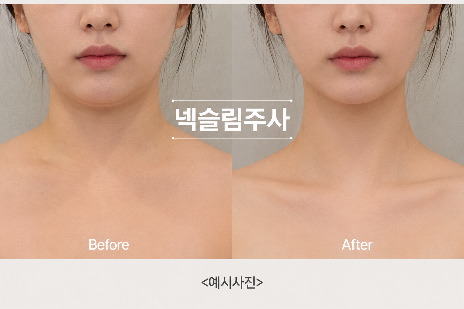 대전도안 뷰티온의원 :: 넥슬림주사