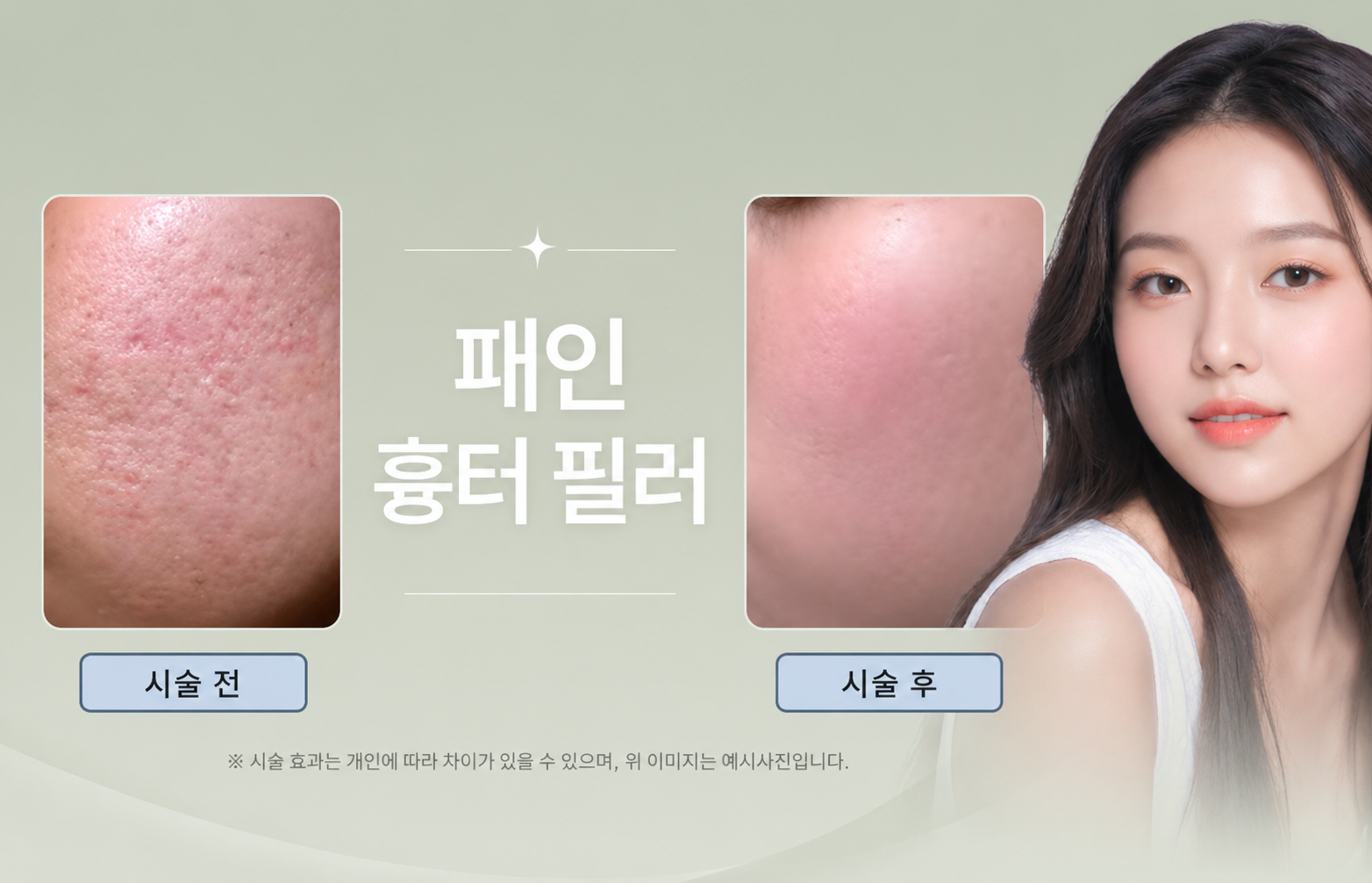 대전도안 뷰티온의원 :: 패인흉터필러
