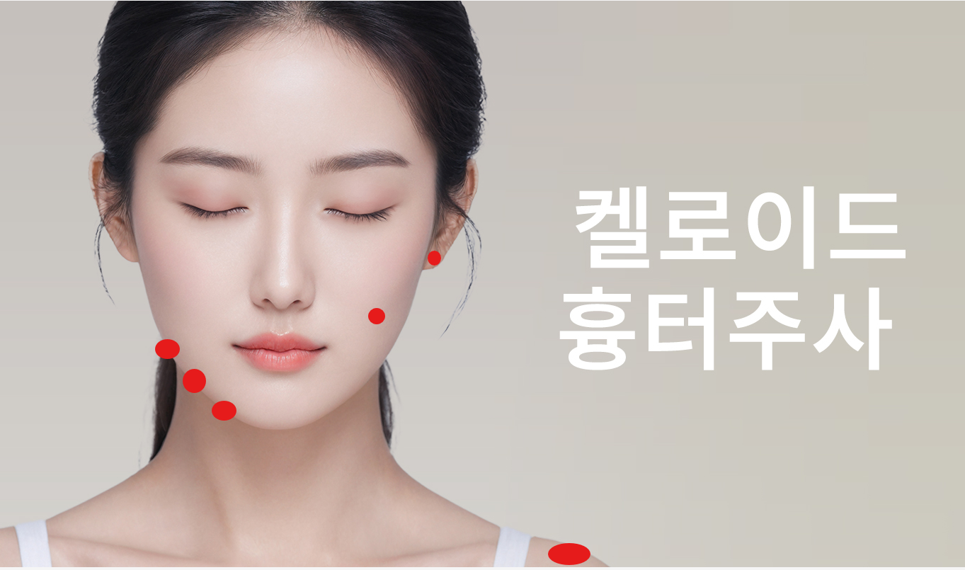 대전도안 뷰티온의원 :: 켈로이드흉터(비후성반흔)주사