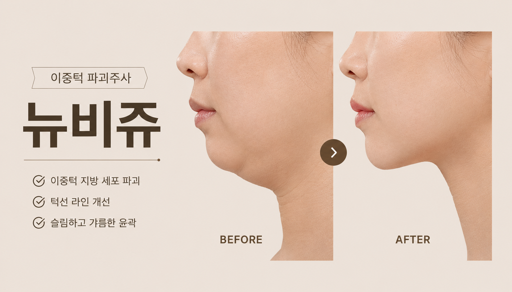 뷰티온의원 통영점 :: 프리미엄 이중턱 주사(뉴비쥬)