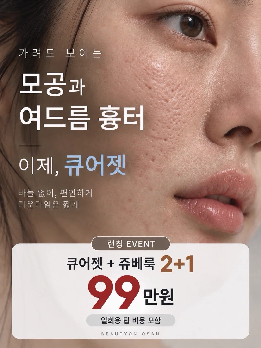 [NEW]모공 흉터, 큐어젯 런칭