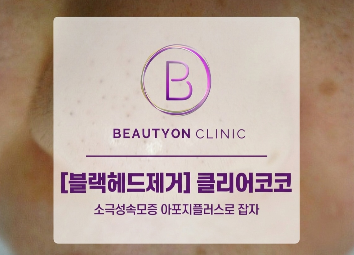 뷰티온의원 화성향남점 :: 블랙헤드(클리어코코)