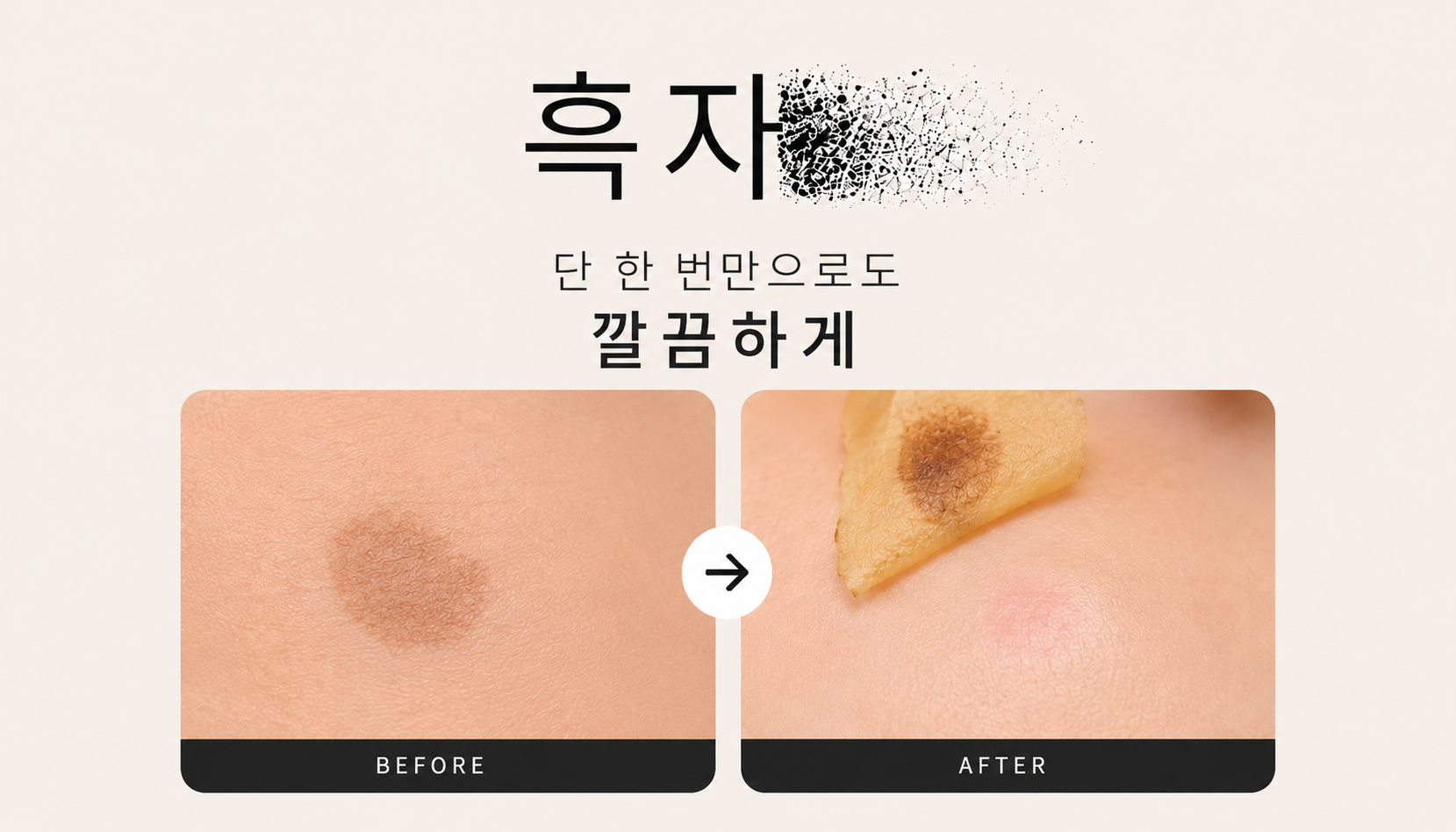 뷰티온의원 화성향남점 :: 흑자 제거 (피코슈어 줌패스)