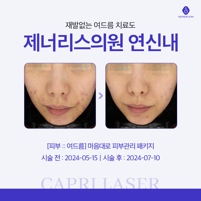 연신내피부과 :: 카프리 레이저