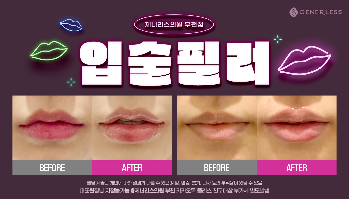부천피부과 :: 💋입술필러 이벤트💋