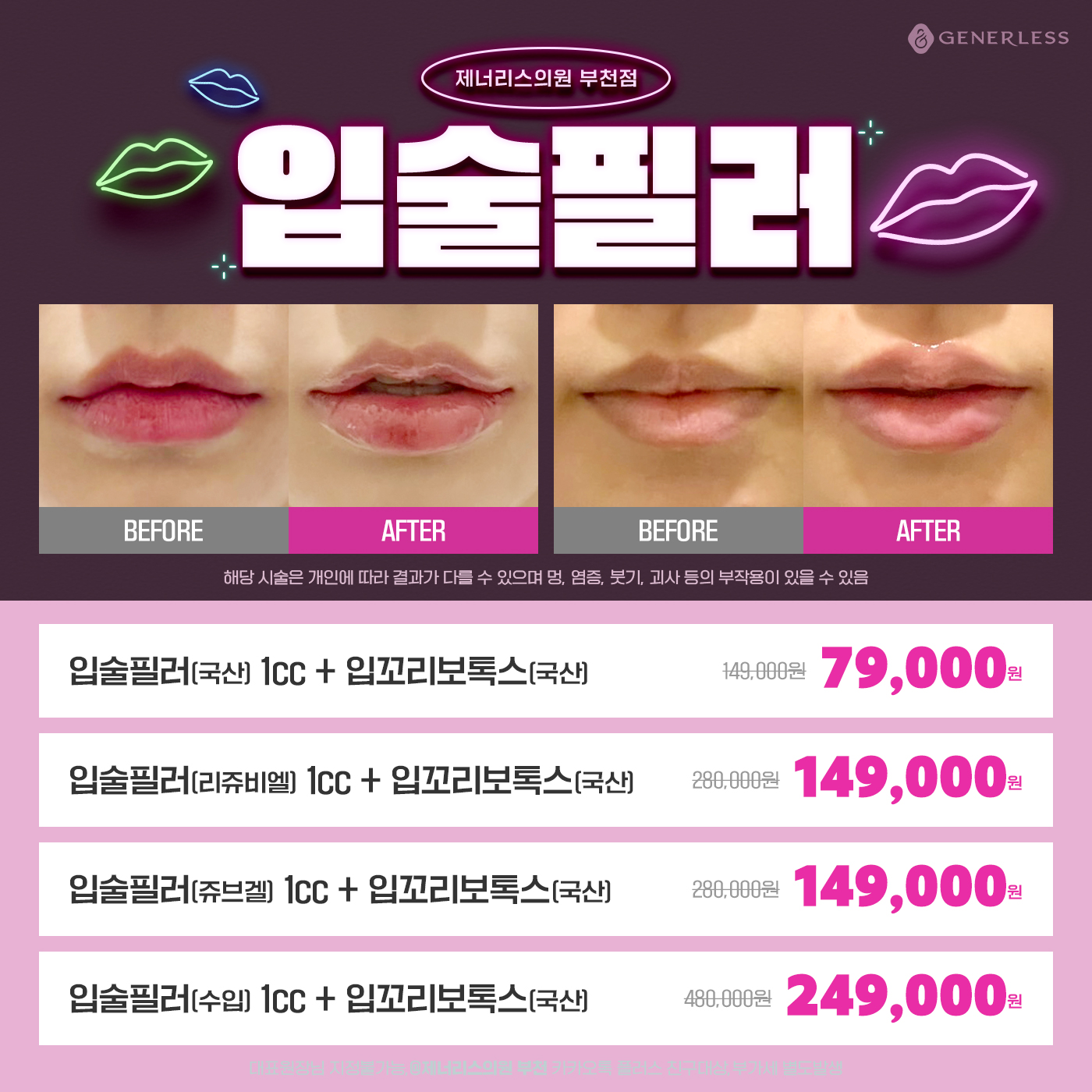 💋입술필러 이벤트💋
