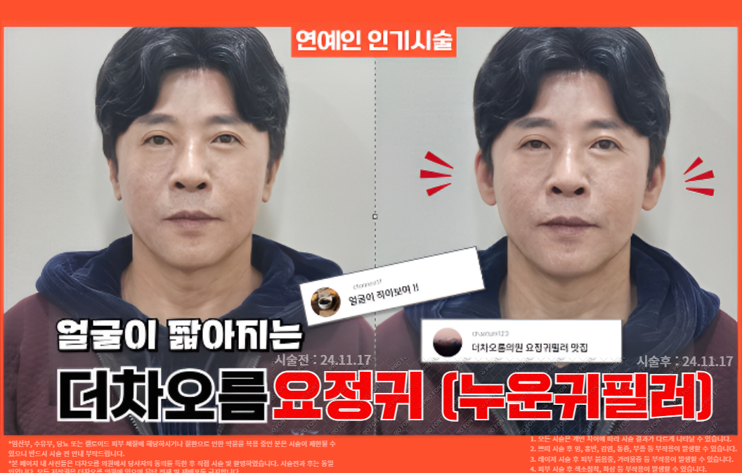 더 차오름의원 :: 더차오름 요정귀 (누운귀필러)