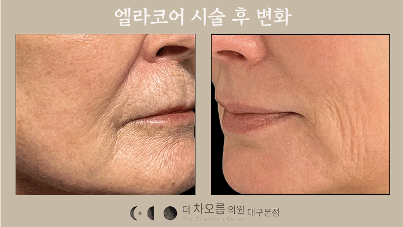 더 차오름의원 :: 엘라코어