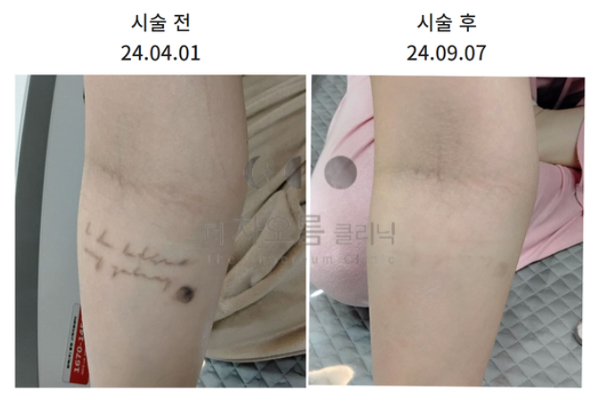더 차오름의원 :: 더차오름의원 특별한 문신제거 