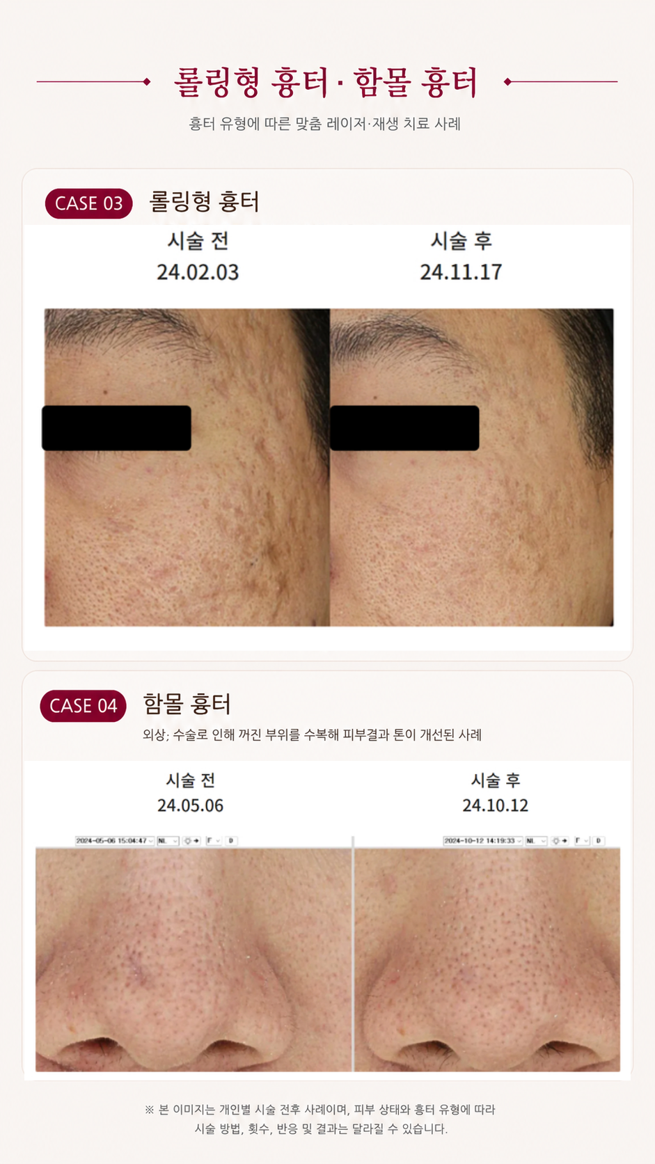 더 차오름의원 :: 더차오름 시그니처 흉터치료 프로그램 