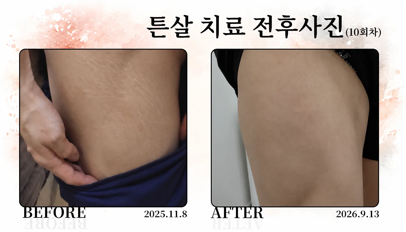 대구피부과 더차오름의원 대구본점 :: 더차오름 튼살치료 프로그램