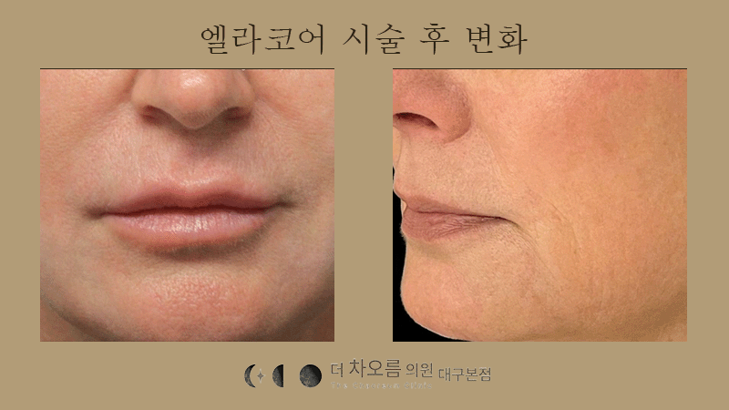더 차오름의원 :: 엘라코어