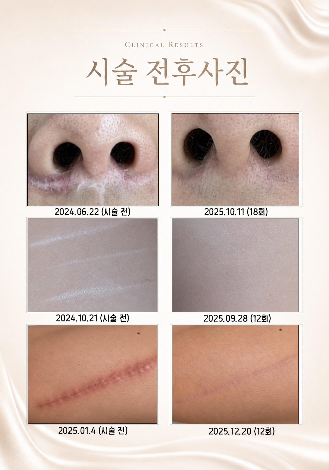 더 차오름의원 :: 흉터 리페어 6주 프로그램