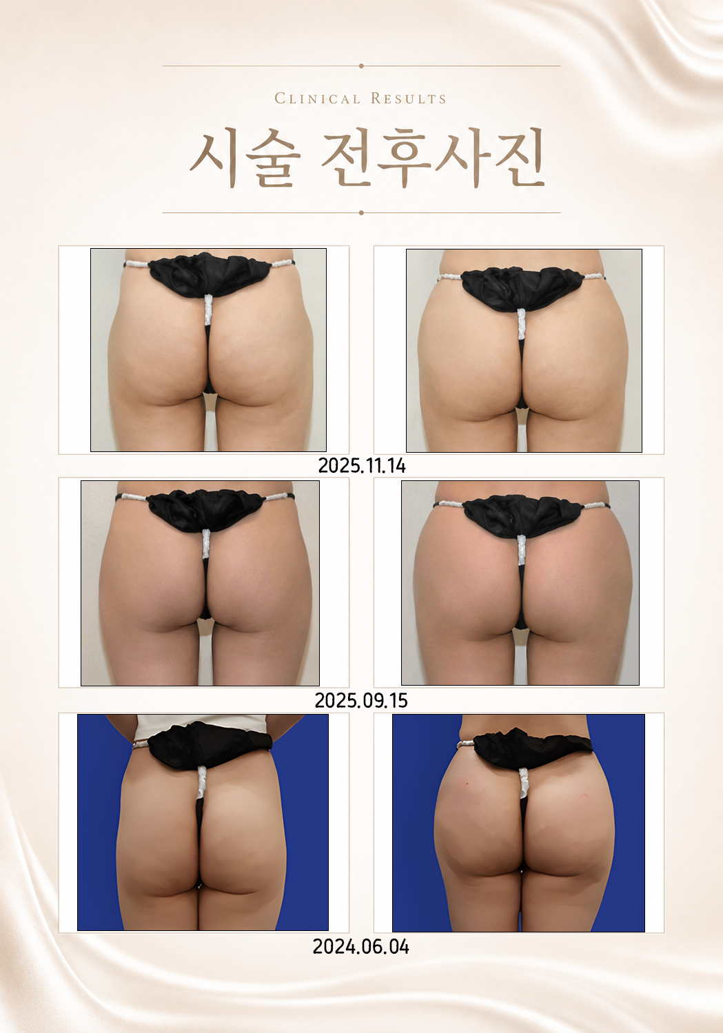 더 차오름의원 :: 엉덩이 필러