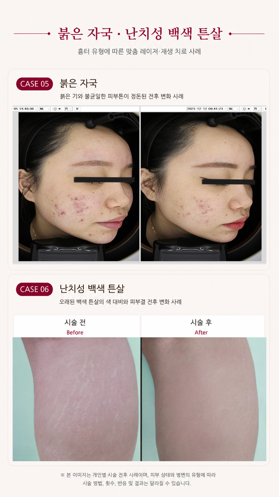 더 차오름의원 :: 더차오름 시그니처 흉터치료 프로그램 