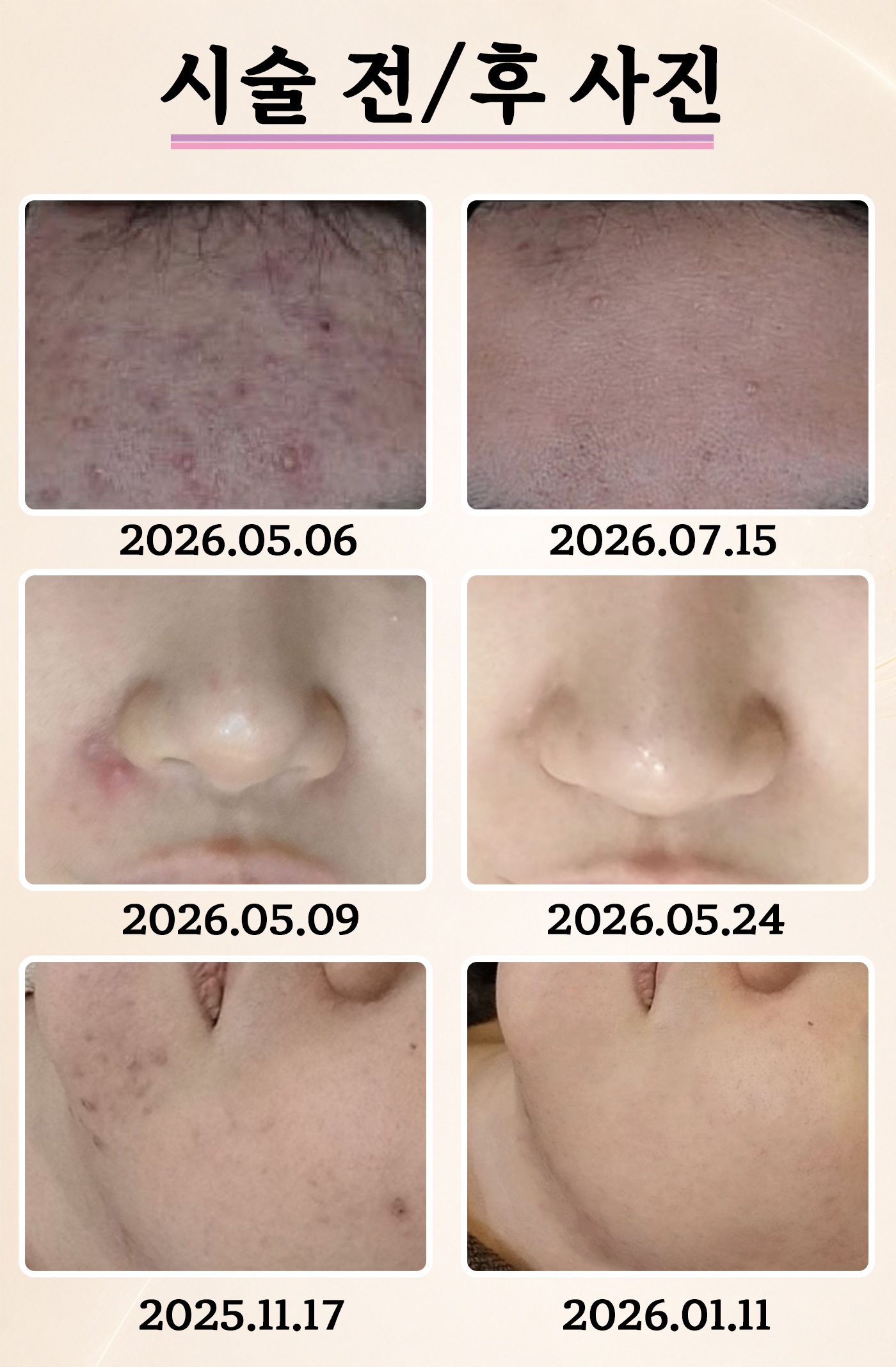 더 차오름의원 :: 2DERMA 골드 PTT