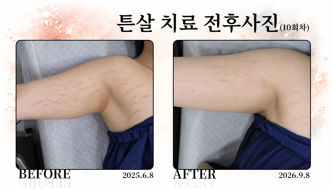 대구피부과 더차오름의원 대구본점 :: 더차오름 튼살치료 프로그램