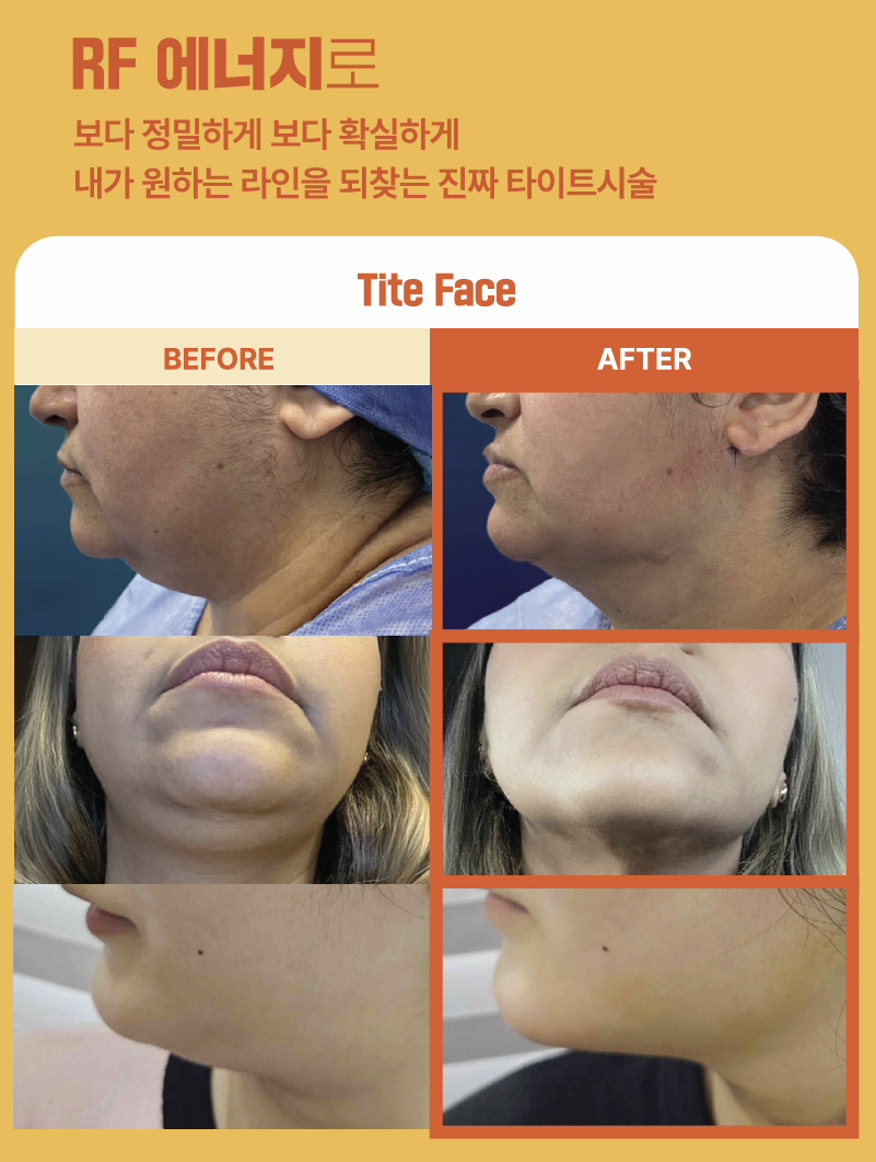 더 차오름의원 :: 인사이드 써마지 (아포렉스 타이트)