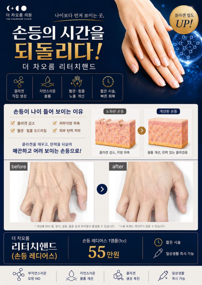 더 차오름의원 :: 손등 레디어스