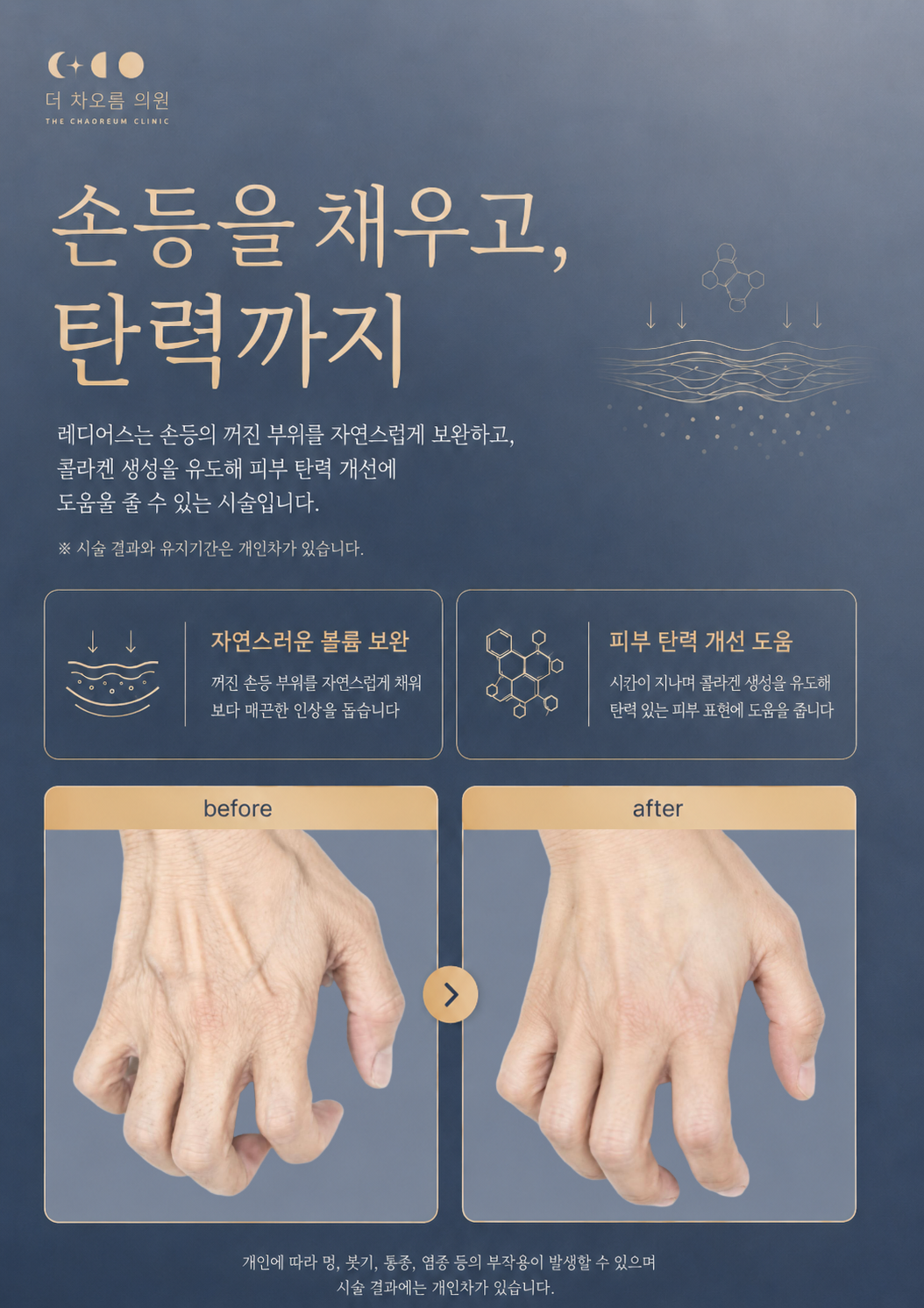 더 차오름의원 :: 손등 레디어스