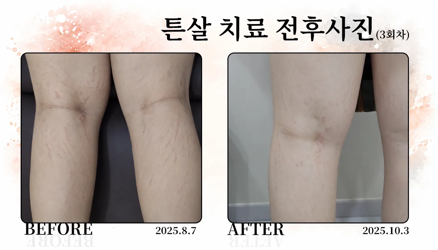 대구피부과 더차오름의원 대구본점 :: 더차오름 튼살치료 프로그램