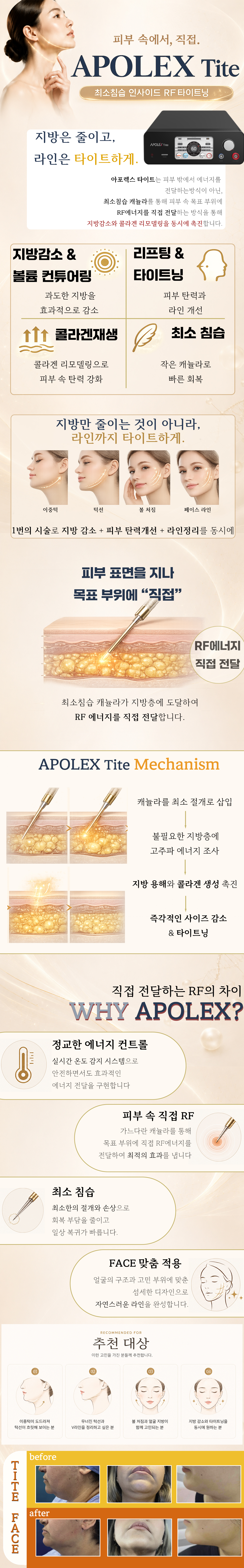 더 차오름의원 :: 인사이드 써마지 (아포렉스 타이트)