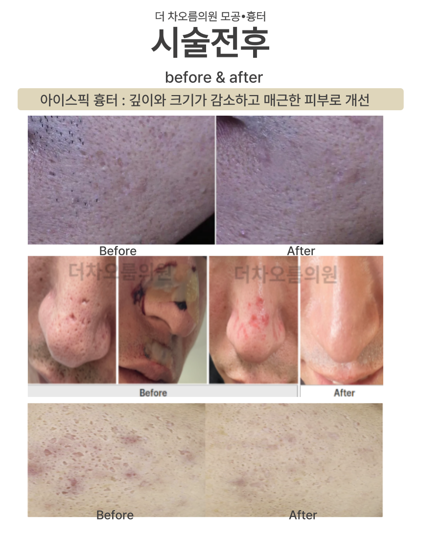 부산피부과 | 더차오름의원 부산점 - 리프팅, 보톡스, 피부레이저 :: 더차오름 시그니처 흉터치료 프로그램 