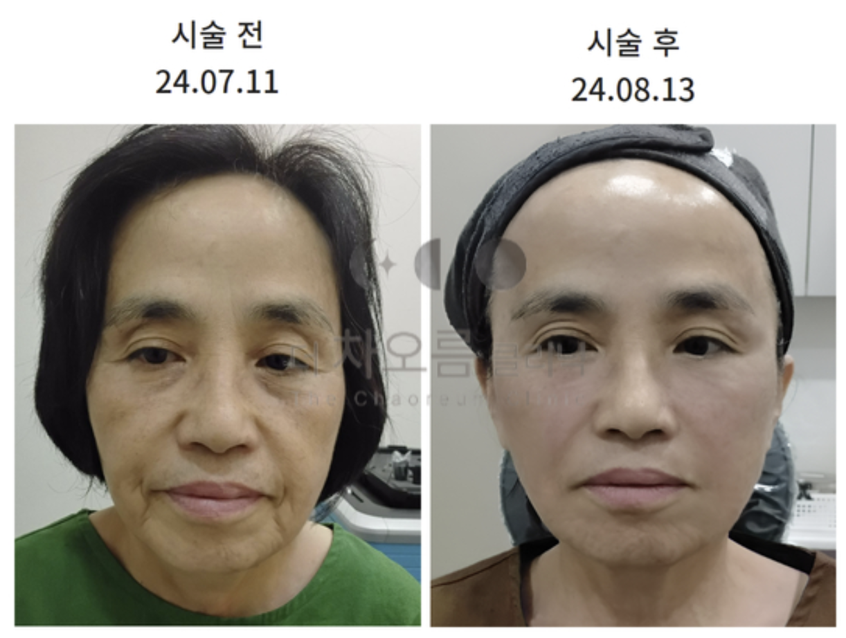 부산피부과 | 더차오름의원 부산점 - 리프팅, 보톡스, 피부레이저 :: 레디어스