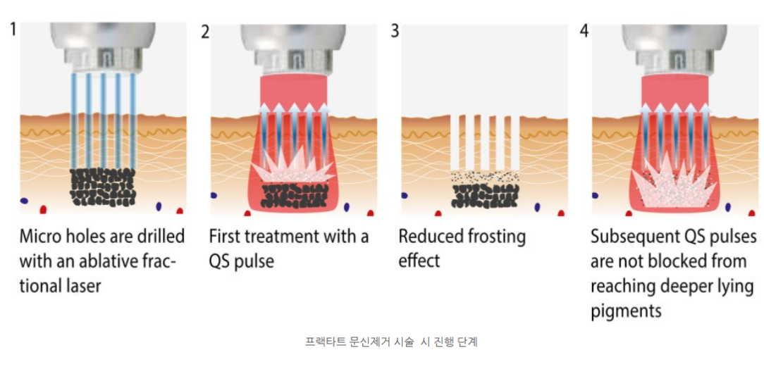 부산피부과 | 더차오름의원 부산점 - 리프팅, 보톡스, 피부레이저 :: 더차오름의원 특별한 문신제거 