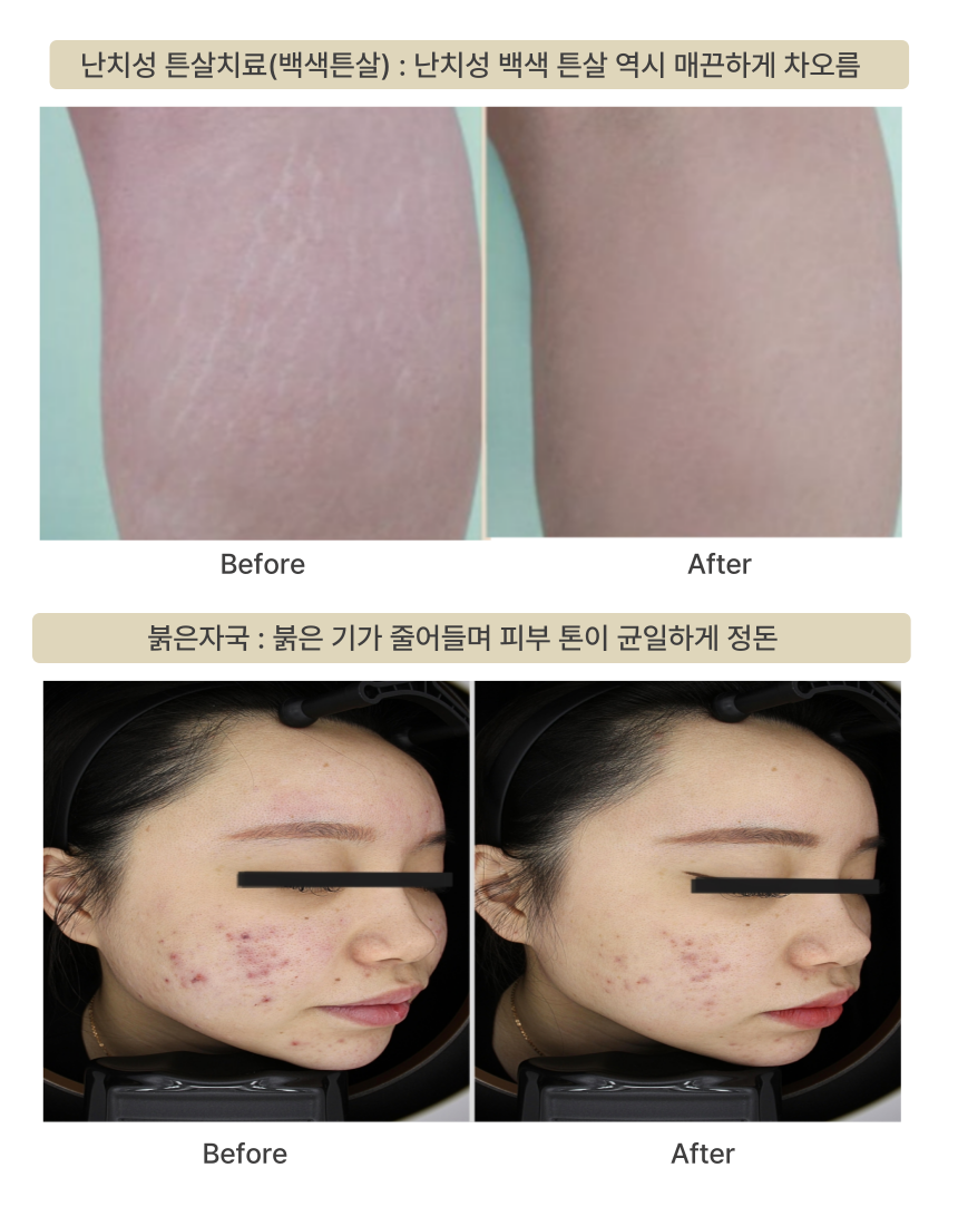 부산피부과 | 더차오름의원 부산점 - 리프팅, 보톡스, 피부레이저 :: 더차오름 시그니처 흉터치료 프로그램 