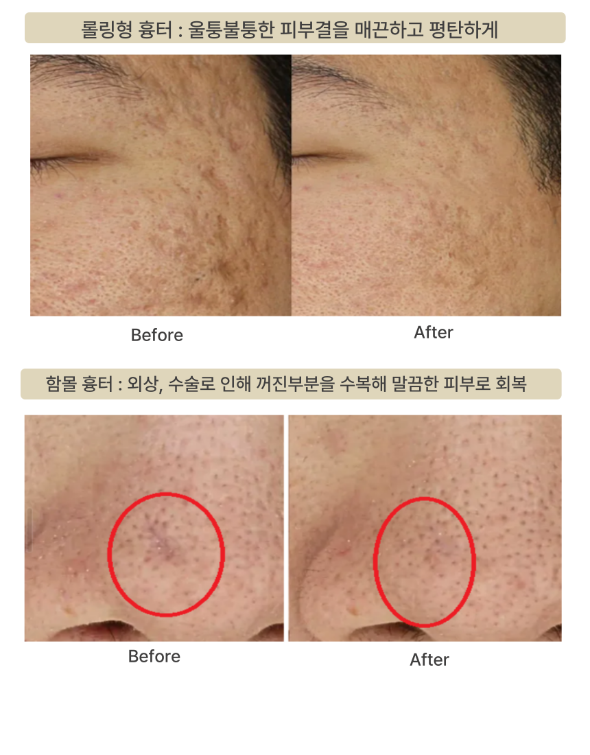 부산피부과 | 더차오름의원 부산점 - 리프팅, 보톡스, 피부레이저 :: 더차오름 시그니처 흉터치료 프로그램 