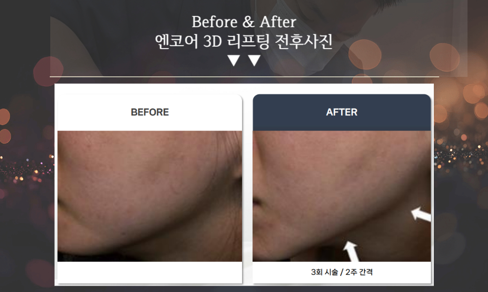 부산피부과 | 더차오름의원 부산점 - 리프팅, 보톡스, 피부레이저 :: K티타늄 리프팅(3D 엔코어리프팅) 