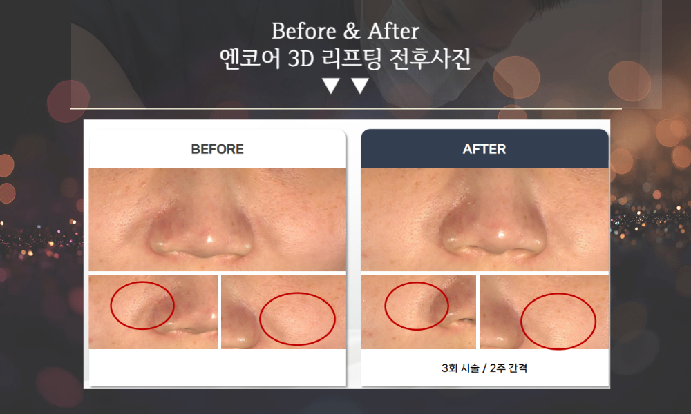 부산피부과 | 더차오름의원 부산점 - 리프팅, 보톡스, 피부레이저 :: K티타늄 리프팅(3D 엔코어리프팅) 