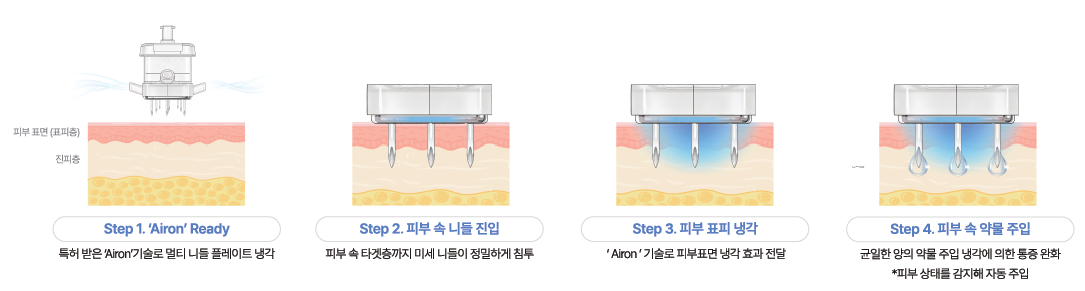 부산피부과 | 더차오름의원 부산점 - 리프팅, 보톡스, 피부레이저 :: 엑스인젝터(무통주입기)