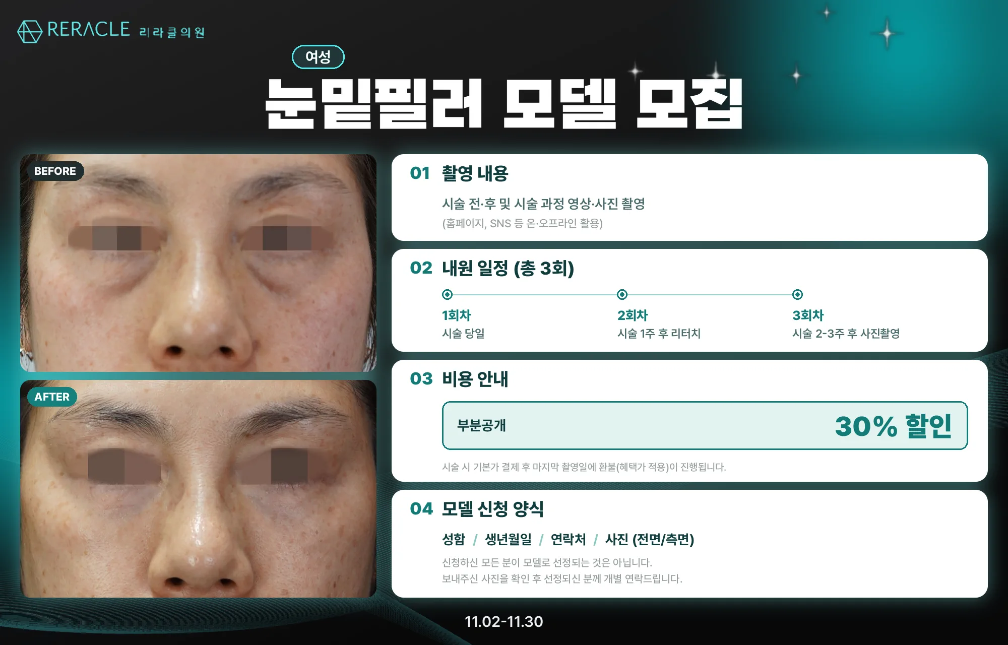 🤍눈밑필러모델 모집🤍