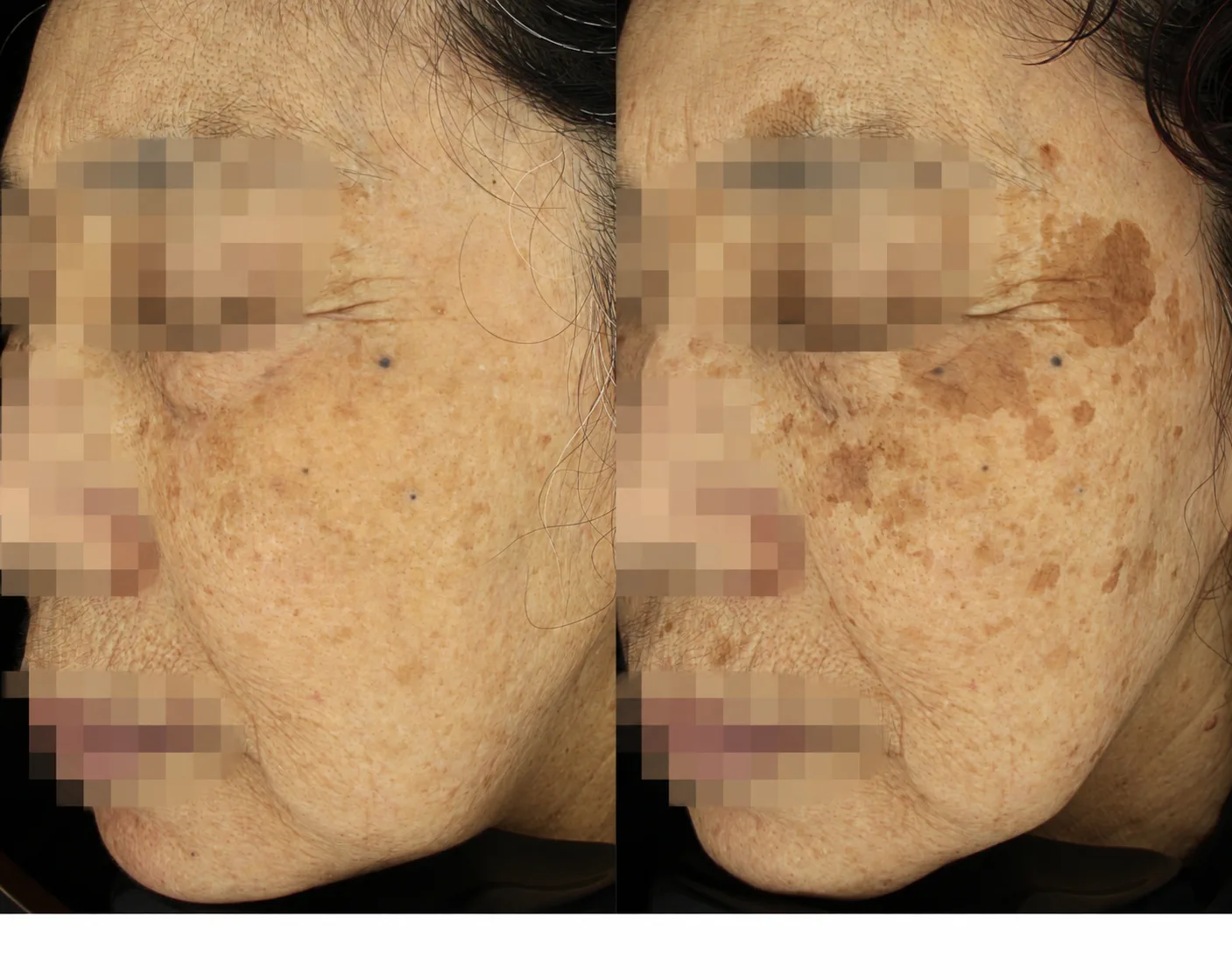청주피부과 리라클의원 :: 리팟 레이저 (시그니처 흑자 제거 레이저)