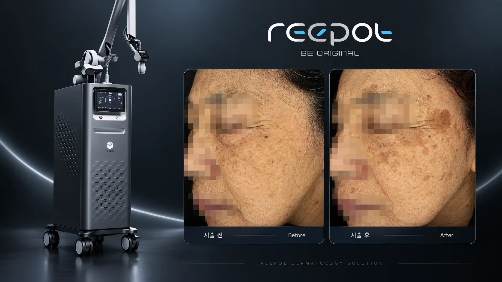 리라클의원 청주 피부과 진료 (보톡스, 필러, 리프팅) :: 리팟 레이저 (시그니처 흑자 제거 레이저)