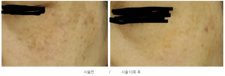 리라클의원 청주 피부과 진료 (보톡스, 필러, 리프팅) :: 색소 시술 팁