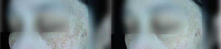 리라클의원 청주 피부과 진료 (보톡스, 필러, 리프팅) :: 색소 시술 팁