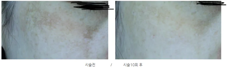 리라클의원 청주 피부과 진료 (보톡스, 필러, 리프팅) :: 색소 시술 팁