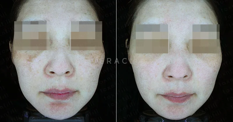 리라클의원 청주 피부과 진료 (보톡스, 필러, 리프팅) :: 색소 시술 팁
