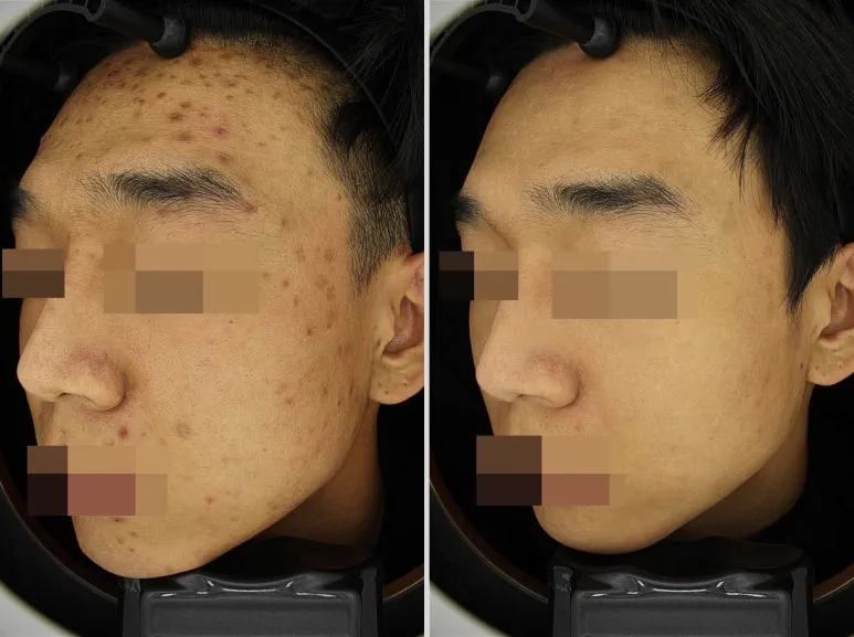 리라클의원 청주 피부과 진료 (보톡스, 필러, 리프팅) :: 색소 시술 팁