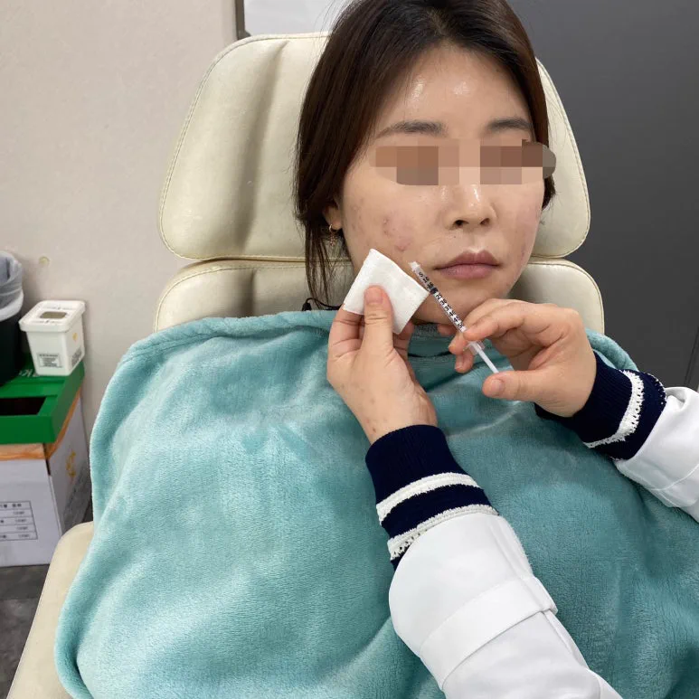 리라클의원 청주 피부과 진료 (보톡스, 필러, 리프팅) :: 색소 시술 팁