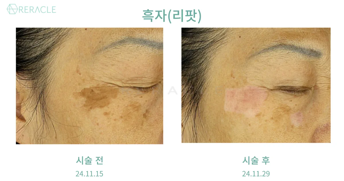 리라클의원 청주 피부과 진료 (보톡스, 필러, 리프팅) :: 색소 시술 팁