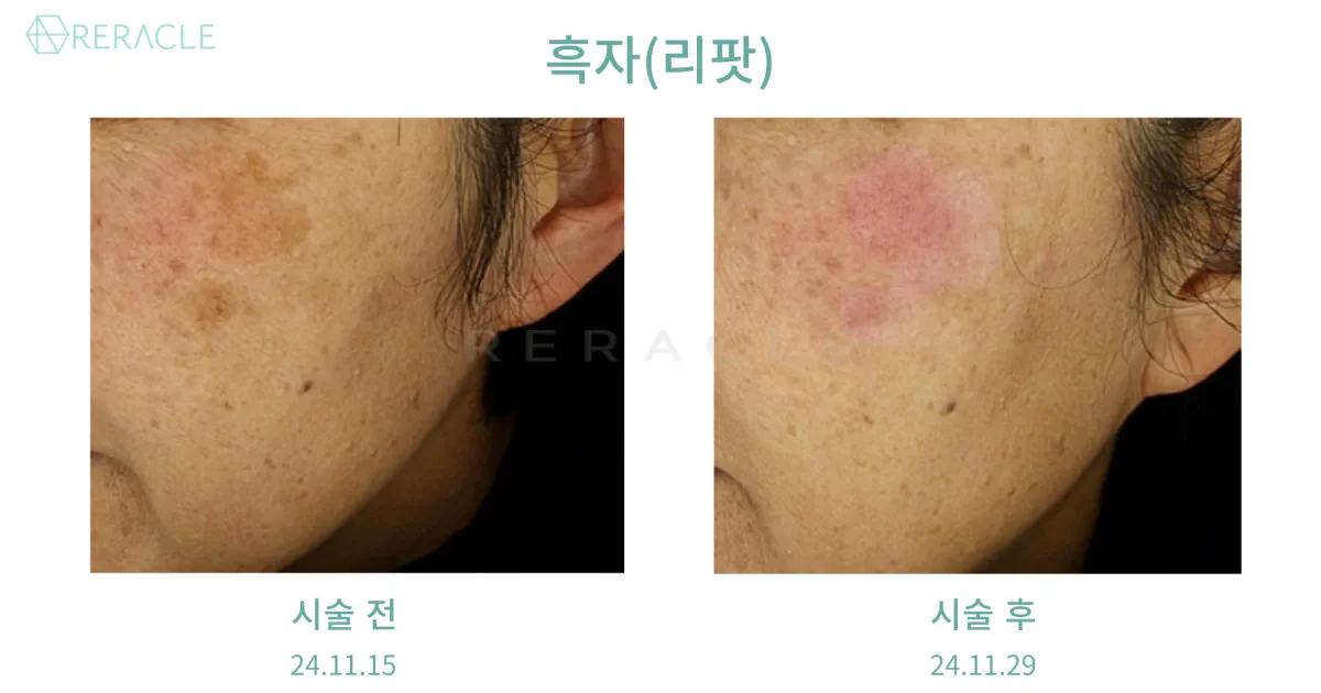 리라클의원 청주 피부과 진료 (보톡스, 필러, 리프팅) :: 색소 시술 팁