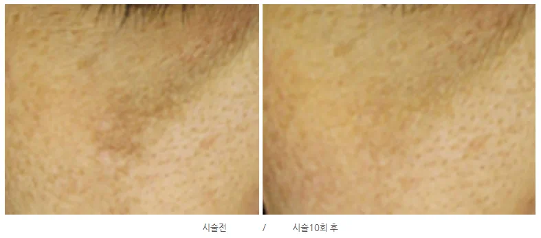 리라클의원 청주 피부과 진료 (보톡스, 필러, 리프팅) :: 색소 시술 팁